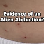 Woman shows off the strange triangle shaped pattern of red dots that might be signs of an alien abduction.