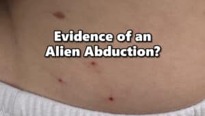 Woman shows off the strange triangle shaped pattern of red dots that might be signs of an alien abduction.