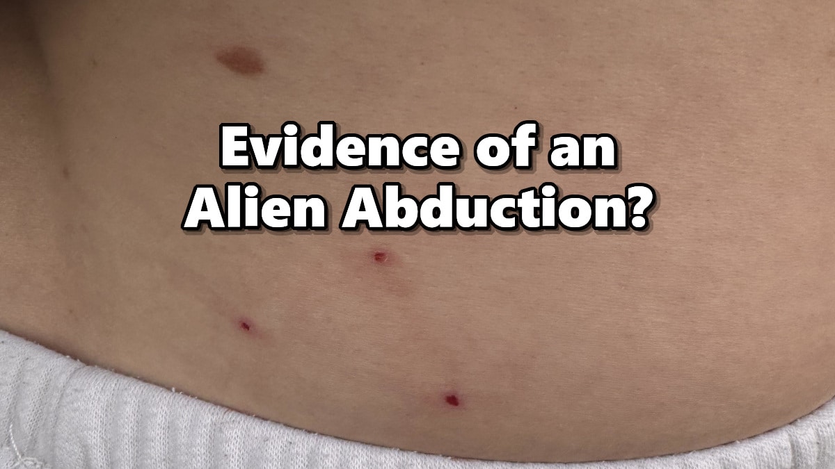 Woman shows off the strange triangle shaped pattern of red dots that might be signs of an alien abduction.